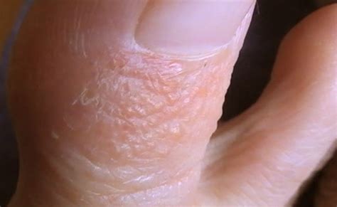 Pompholyx Dyshidrosis Pictures Symptoms Causes And Treatment – Otosection