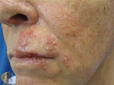 Identifying Skin Rashes Shingles