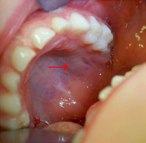 Cancer Of The Soft Palate Prognosis - CancerWalls