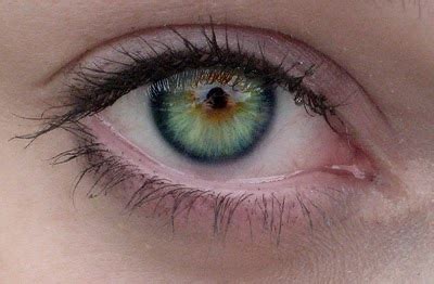 Sectoral Heterochromia Blue And Green