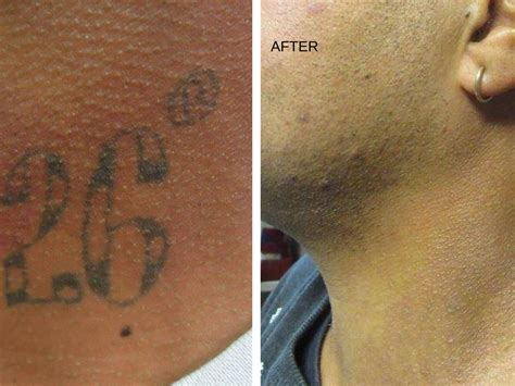 Before and after photos of laser tattoo removal are important ...