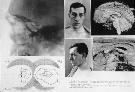 Craniopharyngioma (Endonasal Approach) | The Neurosurgical Atlas