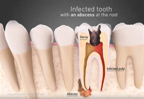 Wisdom Tooth Cyst On Gum