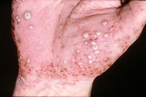 What does pustular psoriasis look like and how is it different?