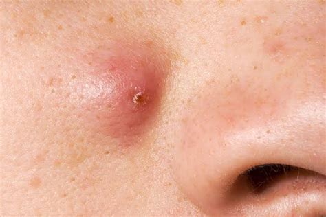 What Is Sebaceous Cyst? Symptoms And Causes - Home Natural Cures