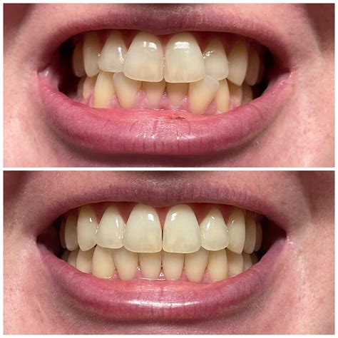 14 trays of invisalign lite later! : r/Invisalign