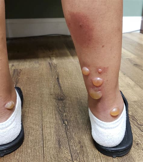 Top 105+ Pictures Pictures Of Blood Blisters Updated