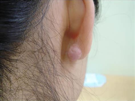 Keloid on ear: Causes, treatment, and prevention