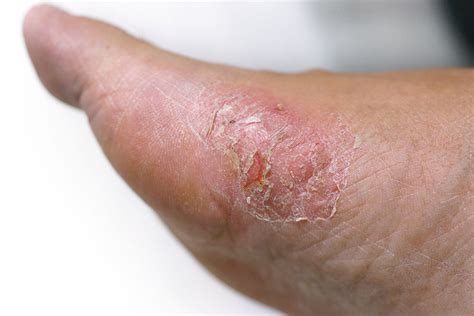 Diabetes and Skin Problems: Know About Diabetic Skin Disorder Causes ...