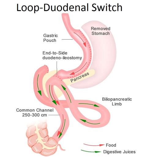 Loop Duodenal Switch Surgery (SADI-S/SIPS) Brisbane, Gold Coast