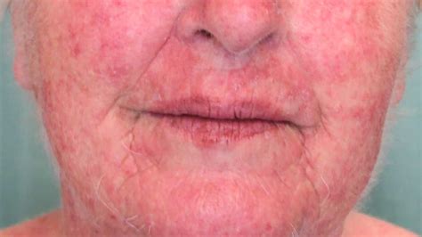 Photoallergic Contact Dermatitis Face