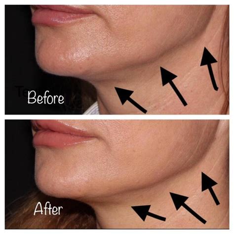 Botox for Jowls: Efficacy, Before & Afters, Side Effects, Cost and More