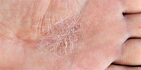 6 Eczema Symptoms You Should Bring Up With Your Derm | SELF