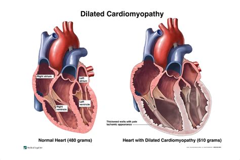 Cardiomyopathy - Types | NHLBI, NIH