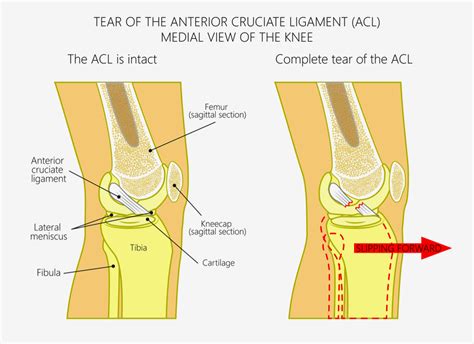 ACL Injuries: 5 Common Causes and Symptoms | Physical Therapy