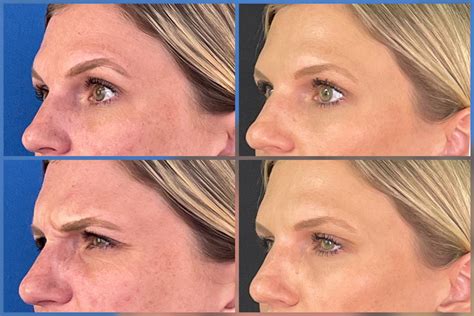 Botox, Dysport & Daxxify Before & After Images • ReFresh Aesthetic ...