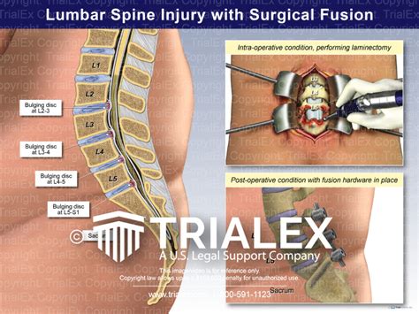 Lumbar Spine Injury with Surgical Fusion - TrialQuest Inc.