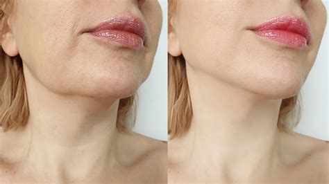 How A Lymphatic Massage Can Get Rid Of Your Double Chin