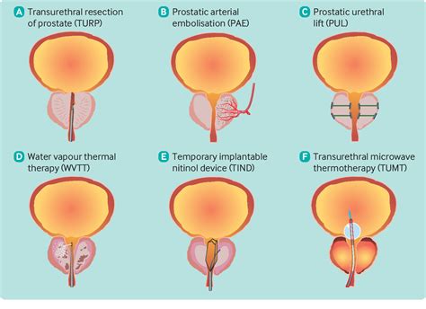 What is the role of minimally invasive surgical treatments for benign ...