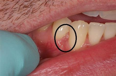 Gingival cyst of the adult - Gingival cyst treatment - Bauer Smiles