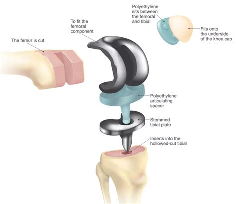 Patient's Guide to Total Knee Replacement - ATX Orthopedics