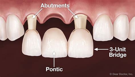 Dental Bridge Abutment