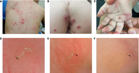 Frontiers | Dermoscopic features of children scabies