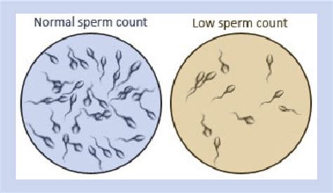 Oligospermia Causes, Symptoms And Treatment