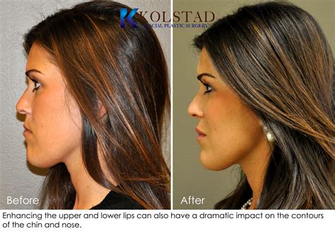 Lip Augmentation Before & After Gallery | Dr. Kolstad - San Diego ...