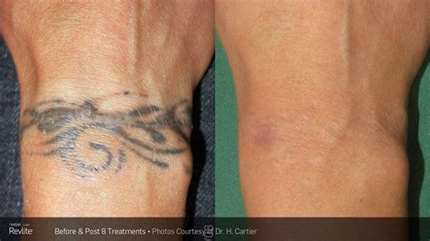 dermabrasion tattoo removal before and after - diers-annon