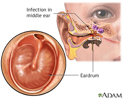 When Should You Go To The Physician For An Ear Infection? - AtoAllinks