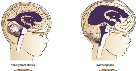 Best Drs & Hospitals in India for Hydrocephalus Treatment