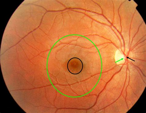 Normal Retinal Anatomy - The Retina Reference