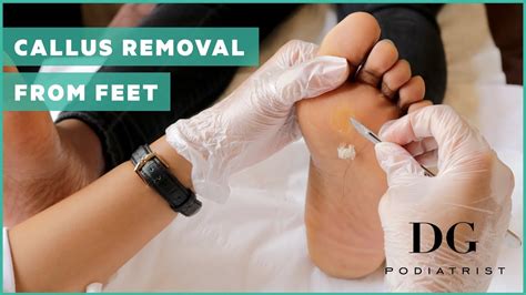 Hard Skin On Ball Of Foot Removal Online | bellvalefarms.com