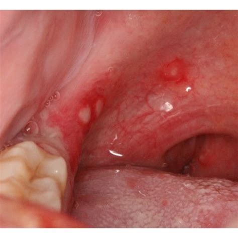 Herpes zoster presenting as small and coalesced ulcers with scalloped ...