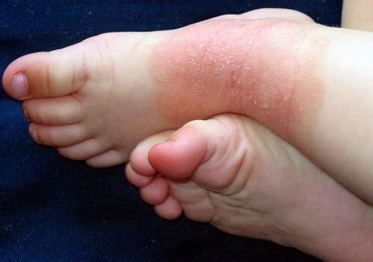 Foot Eczema: Causes, Symptoms & Treatment - Foot Pain Explored (2022)