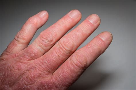 Psoriatic Arthritis (PsA): Symptoms, Causes & Treatment Options - Page ...