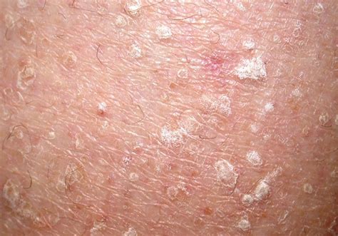 Seborrheic Keratosis Seborrheic Keratosis Cure | Images and Photos finder