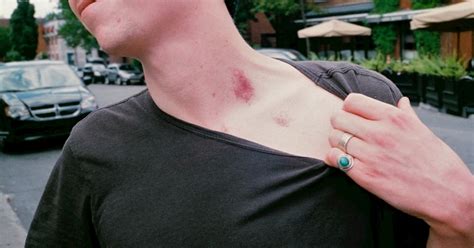 Science Explains How a Hickey Can Kill You