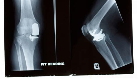 Partial Knee Replacement in Singapore | Oxford Orthopaedics