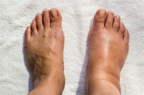 Why are My Feet Swollen? | Put Your Feet First