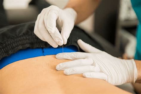 Dry Needling for Back Pain | Sports Focus Physiotherapy | Blog