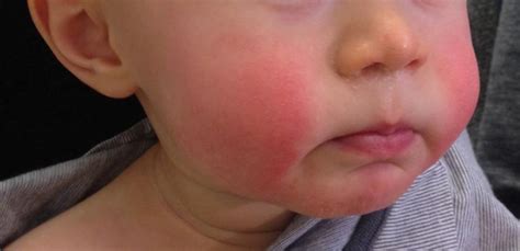 What is slapped cheek syndrome? | Family Corner