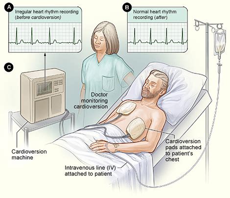 Cardioversion - Baltimore Cardiologists - Woodholme Cardiovascular ...