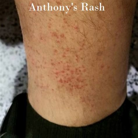 The Disney Rash - Description, prevention and treatment