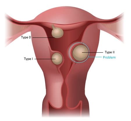 Submucosal Fibroids | Uterine Fibroids | KJK Hospital, Trivandrum