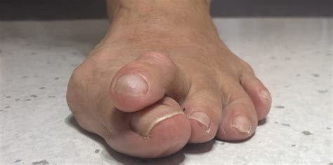 Hammer Toes: Causes, Diagnosis, Treatment - Foot And Ankle