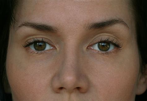 Ptosis Palpebral: ¿Tiene Tratamiento? | Área Oftalmológica