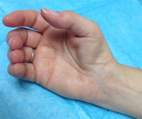 Thenar Muscle Atrophy | Hand Surgery Resource