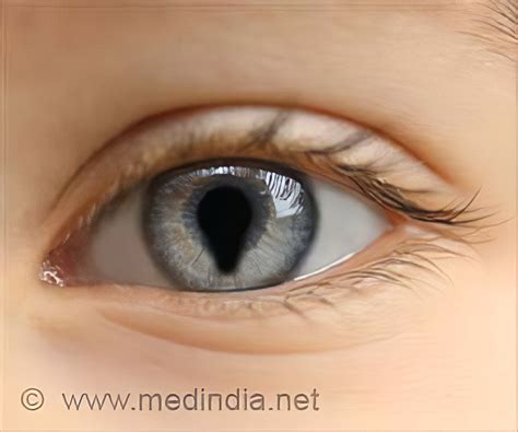 Coloboma - Causes, Symptoms, Diagnosis, Treatment & Prevention